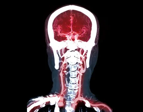 Collection of CTA brain or CT angiography of the brain  comparison Mip techni Stock Illustration