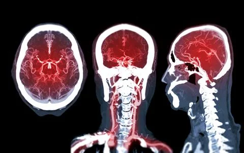 Collection of CTA brain or CT angiography of the brain  comparison Mip techni Stock Illustration