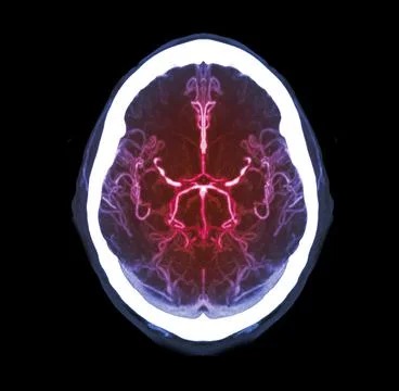Collection of CTA brain or CT angiography of the brain  comparison Mip techni Illustrazione stock