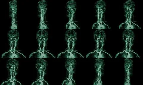 Collection MRA Brain. Stock Photos