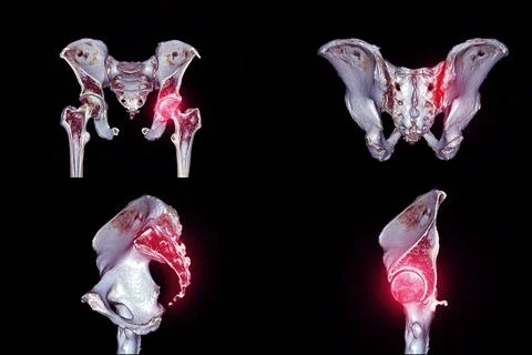Collection of traumatic case CT scan of  pelvic bone. Stock Illustration
