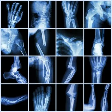 Collection x-ray multiple bone fracture (finger,spine,wrist,hip,leg,clavicle, Stock Photos