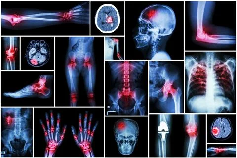 Collection x-ray multiple disease (arthritis,stroke,brain tumor,gout,rheumato Stock Photos