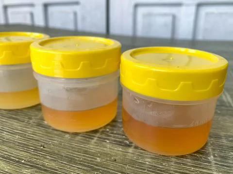 A collection of yellow urine samples on the table for laboratory examination Stock Photos
