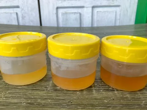 A collection of yellow urine samples on the table for laboratory examination Stock Photos
