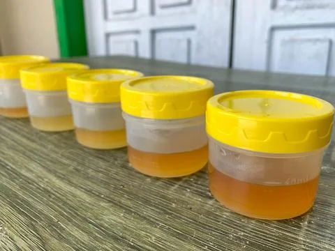 A collection of yellow urine samples on the table for laboratory examination Stock Photos