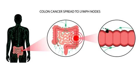 Colon cancer stage Stock Illustration
