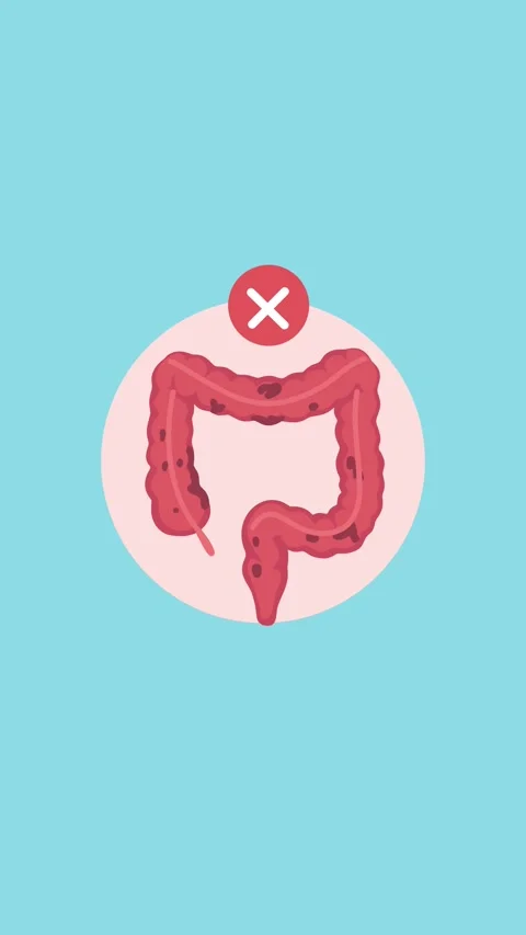 Colon disease animation Stock Footage 340956152