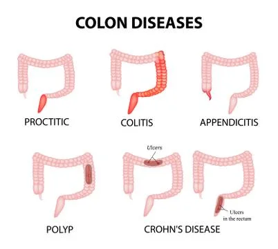 Colon diseases. Proctitis, colitis, appendicitis, polyp, ulcer, Crohn's disease Stock Illustration