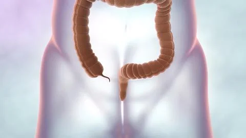 Colon during a enteroscopy with a intestinal or bowel cancer tumor visible. Stock Illustration