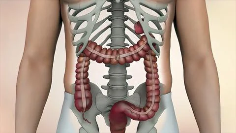 Colon during a enteroscopy with a intestinal or bowel cancer tumor visible. Stock Illustration
