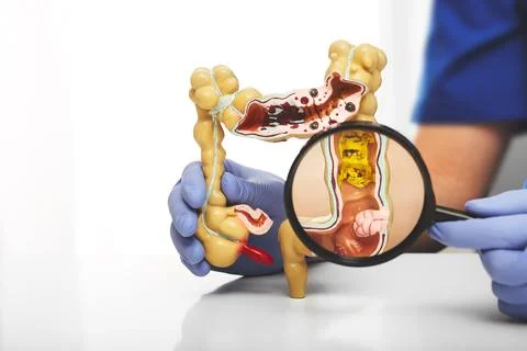 Colon model with different diseases in doctors hands. Colon tumor enlarged in 写真素材