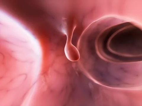 Colon polyp, artwork Stock Illustration