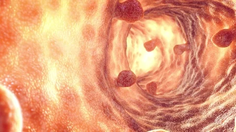 Colon polyps Video stock 333637011