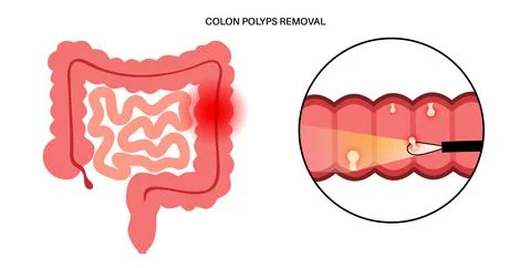 Colon polyps inflammation Ilustração Stock