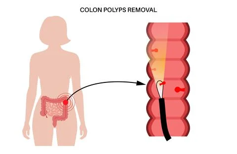 Colon polyps inflammation Stock Illustration