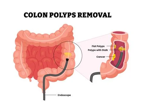 Colon polyps removal with endoscope, flat polyps and cancer with cross sect.. Stock Illustration