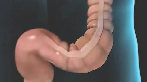 Colonic polyps, extra tissue growing in the colon that can become cancerous. Stock Illustration