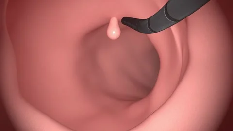 Colonoscope in the colon during a colonoscopy procedure. GI Endoscopy Stock Footage 279790746