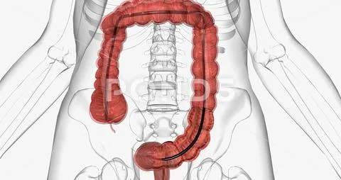 Colonoscopy is an invasive procedure used to look inside the large ...