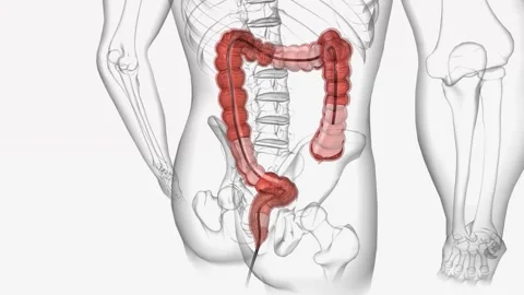 Colonoscopy is a procedure in which a doctor uses a colonoscope or scope, to Stock Footage 244530986