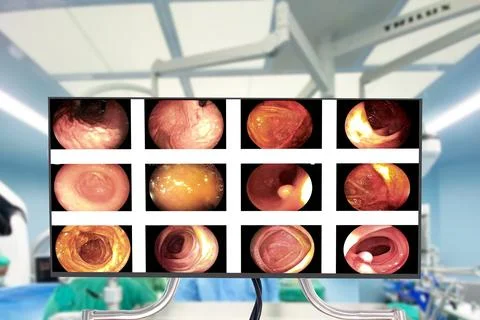 Colonoscopy which treated by surgery  Blurry  hospital operating room for t.. Stock Photos