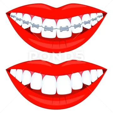 Colorful cartoon teeth aligning elements set Stock Illustration