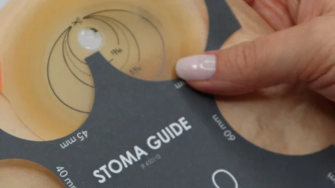 Colostomy bag, supply needed after colostomy surgery. Using stoma guide. Video stock 122126848