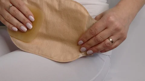 Colostomy bag, supply needed after colostomy surgery - colon cancer treatment. Stock Footage 122316227