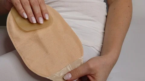 Colostomy bag, supply needed after colostomy surgery - colon cancer treatment. Stock Footage 122316468