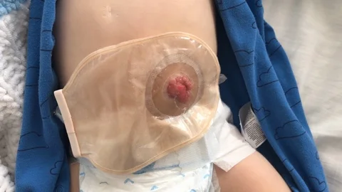 Colostomy pouch attached to baby patient. Ostomy bag. Stock Footage 116243853