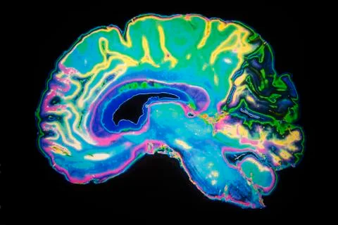 Coloured mri scan of human brain Stock Photos