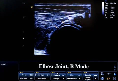 Colourful ultrasound monitor image. Elbow Joint, B Mode Modern echocardiog... Stock Photos