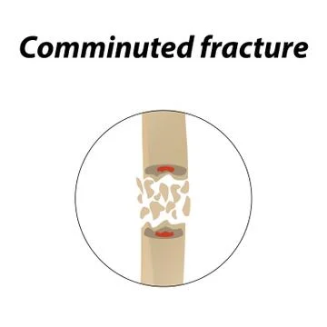 Comminuted fracture Bone. Infographics. Vector illustration on a lined Stock Illustration