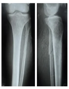Comminuted fracture of the tibia Foto stock