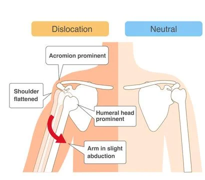 Comparative chart of shoulder joint dislocation mechanism Stock-Illustration