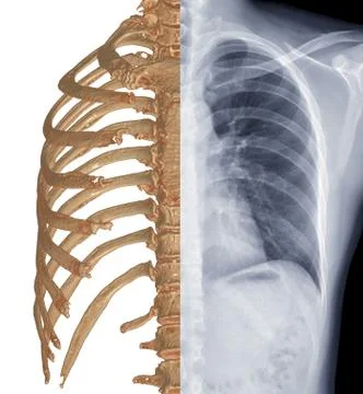 Compare CT  Chest  3D rendering and Chest x-ray . Stock Illustration