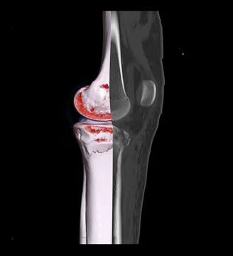 Compare of CT knee joint 3D rendering image and CT knee 2D isolated on black  Stock Illustration