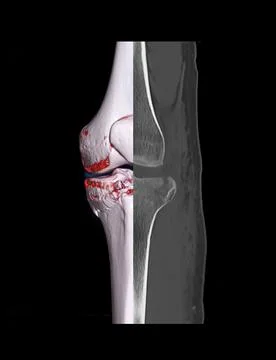 Compare of CT knee joint 3D rendering image and CT knee 2D isolated on black  Stock-Illustration