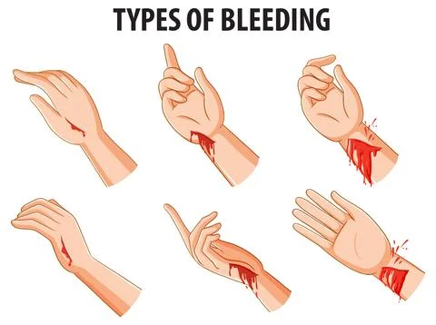 Comparing Different Types of Bleeding on Human Arms Stock Illustration