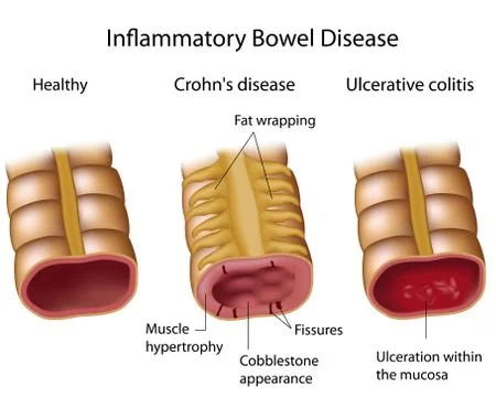 Comparing inflammatory bowel disease Stock-Illustration