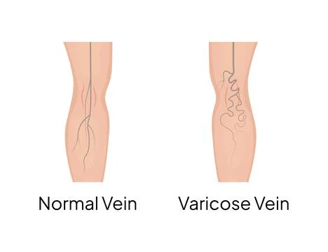 Comparing normal and varicose veins in human leg Stock Illustration