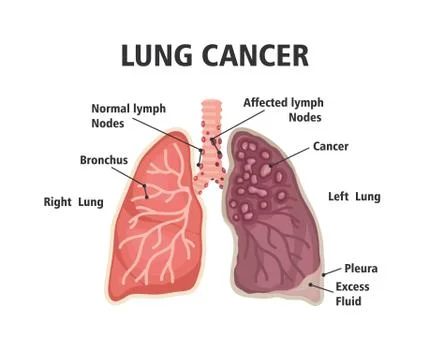 Comparison between healthy lung and cancer lung Stock Illustration