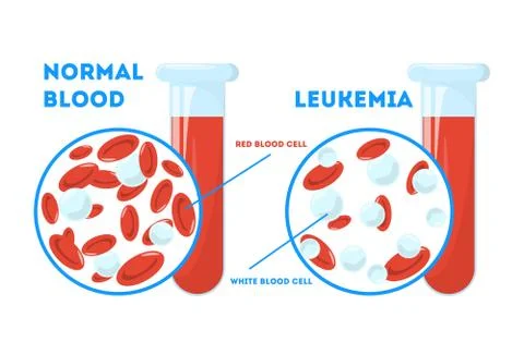 Comparison between normal blood and leukemia. Dangerous Stock Illustration