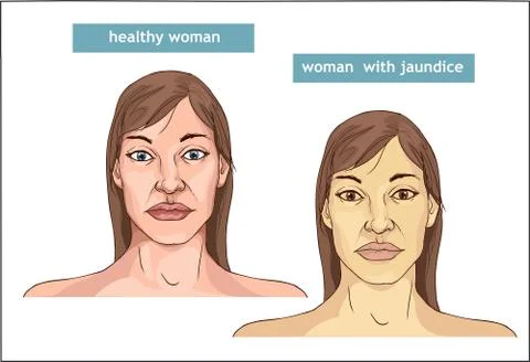The Comparison between normal skin people and yellowing from Jaundice Stock Illustration