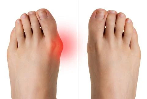 Comparison of bunion before and after correction surgery 스톡 사진