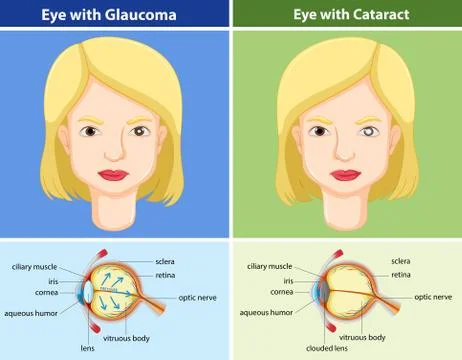 Comparison chart of eyes with and without glaucoma 스톡 일러스트