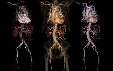 Comparison of CTA abdominal aorta 3D rendering image  with stent graft on tra Stock Illustration