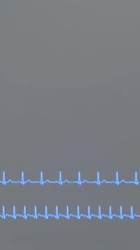 Comparison of ECG of normal heart rhythm and tachycardia. イラスト素材