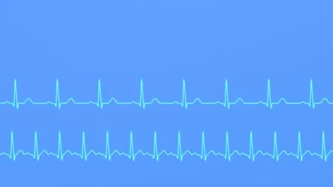 Comparison of ECG of normal heart rhythm and tachycardia. 스톡 일러스트